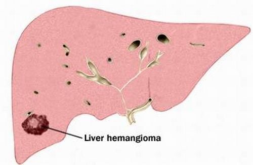 U mạch máu gan - Ảnh minh họa 4