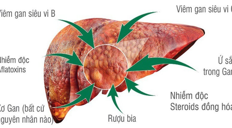 Ung thư gan - Ảnh minh họa 4