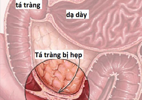 Ung thư tá tràng - Ảnh minh họa 3