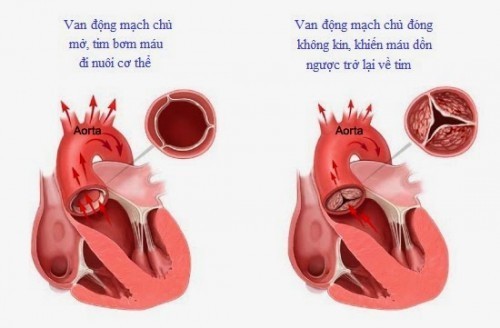 Hở van động mạch chủ - Ảnh minh họa 2