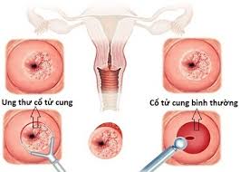 Ung thư cổ tử cung - Ảnh minh họa 3
