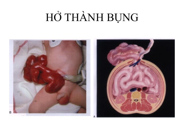 Khiếm khuyết cơ thành bụng - Ảnh minh họa 2