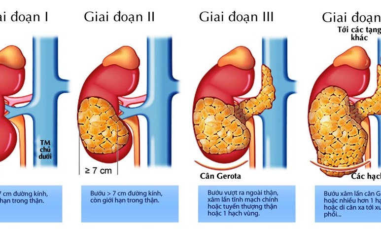Ung thư thận - Ảnh minh họa 1