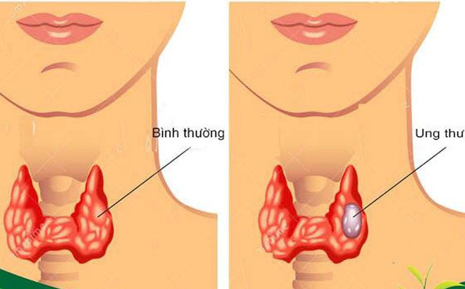 Ung thư tuyến giáp - Ảnh minh họa 1