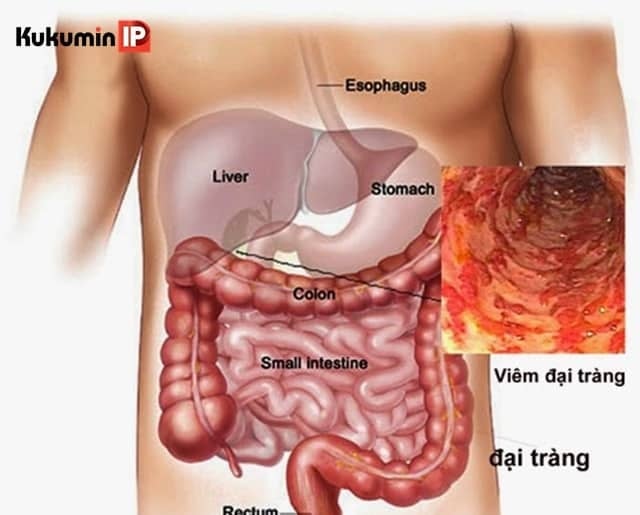 Viêm đại tràng vi thể  - Ảnh minh họa 1