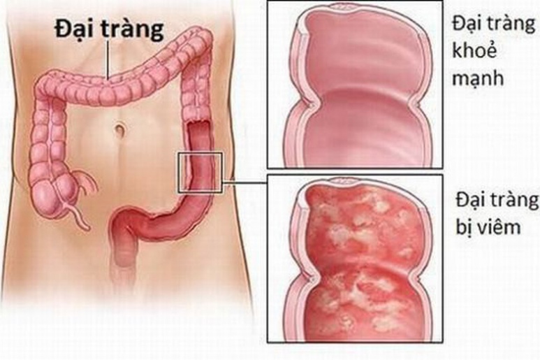 Viêm đại tràng vi thể  - Ảnh minh họa 2