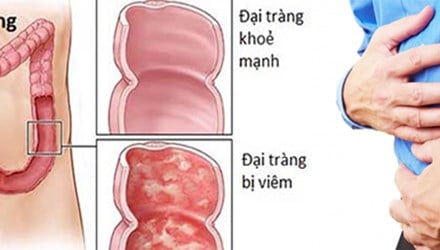 Viêm đại tràng vi thể  - Ảnh minh họa 5