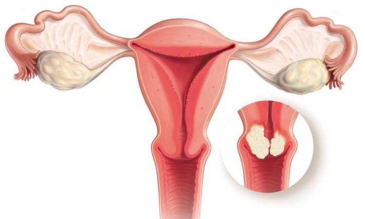 Loạn sản cổ tử cung - Ảnh minh họa 1