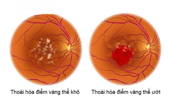 Lỗ hoàng điểm - Ảnh minh họa 1