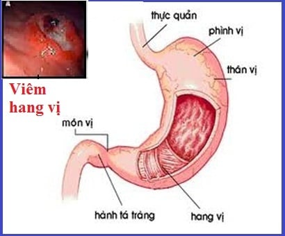 Viêm hang vị dạ dày - Ảnh minh họa 3