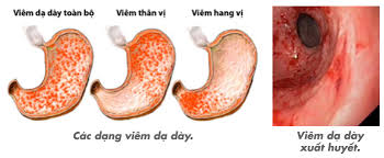 Viêm hang vị dạ dày - Ảnh minh họa 4