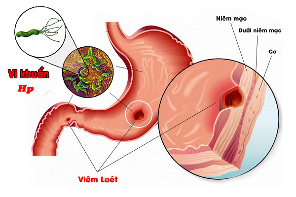 Viêm hang vị dạ dày - Ảnh minh họa 5