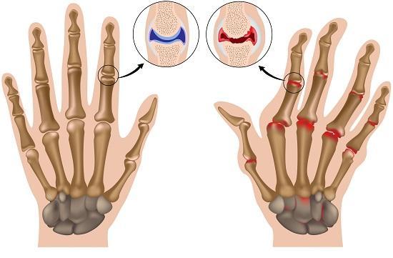 Viêm khớp ngón tay - Ảnh minh họa 3