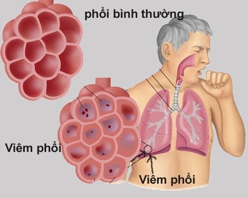 Viêm màng phổi  - Ảnh minh họa 2