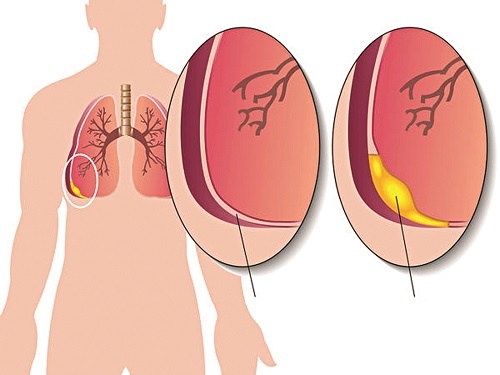 Viêm màng phổi  - Ảnh minh họa 3