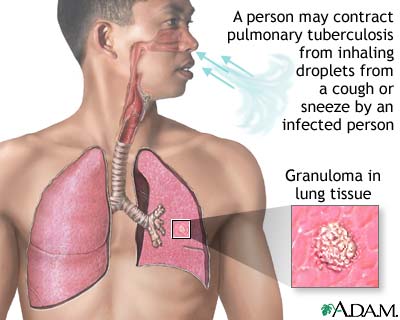 Viêm màng phổi  - Ảnh minh họa 5