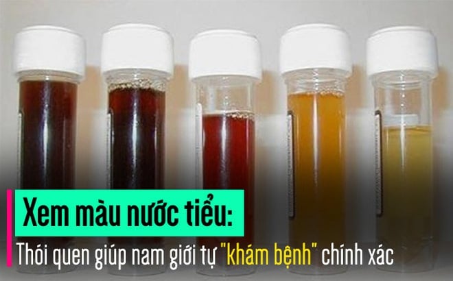 Màu sắc nước tiểu bất thường - Ảnh minh họa 2