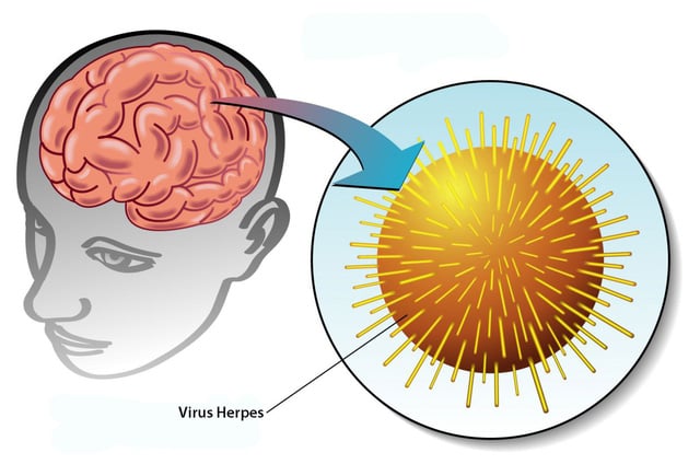 Viêm não Herpes - Ảnh minh họa 3