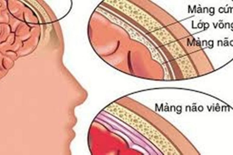 Viêm não Herpes - Ảnh minh họa 4