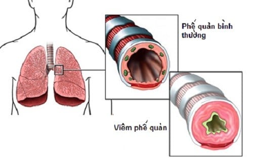 Viêm phế quản cấp - Ảnh minh họa 2