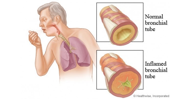 Viêm phế quản cấp - Ảnh minh họa 3