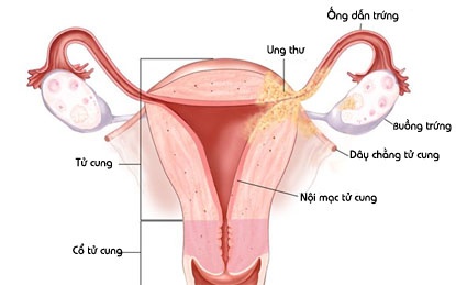 Viêm nội mạc tử cung - Ảnh minh họa 2