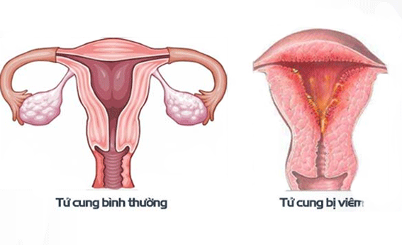 Viêm nội mạc tử cung - Ảnh minh họa 3