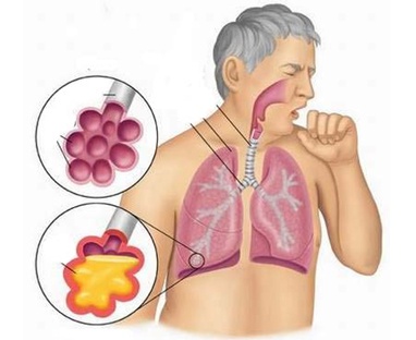 Nhiễm trùng đường hô hấp trên - Ảnh minh họa 1