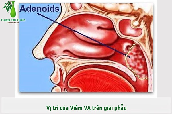 Viêm VA mãn tính - Ảnh minh họa 4