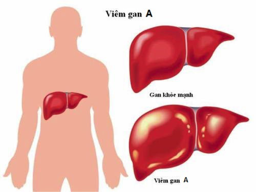 Viêm gan A - Ảnh minh họa 2