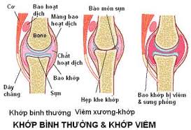 Viêm khớp nhiễm khuẩn - Ảnh minh họa 3