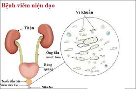 Viêm niệu đạo - Ảnh minh họa 1