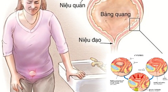 Viêm niệu đạo - Ảnh minh họa 4