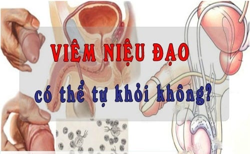 Viêm niệu đạo - Ảnh minh họa 5