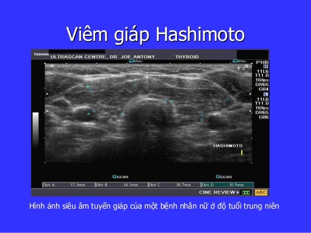 Viêm tuyến giáp Hashimoto - Ảnh minh họa 2