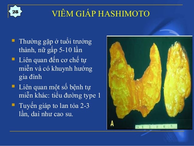 Viêm tuyến giáp Hashimoto - Ảnh minh họa 3