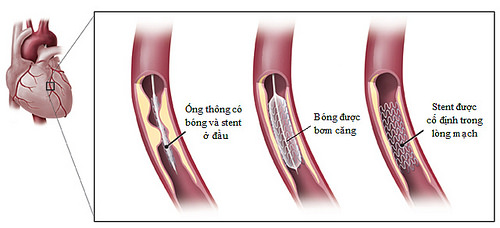 Viêm động mạch - Ảnh minh họa 3