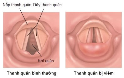 Viêm thanh quản - Ảnh minh họa 4