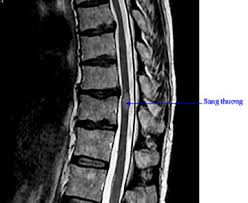 Viêm tủy cắt ngang - Ảnh minh họa 1