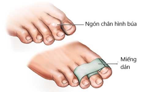 Ngón chân hình búa - Ảnh minh họa 2