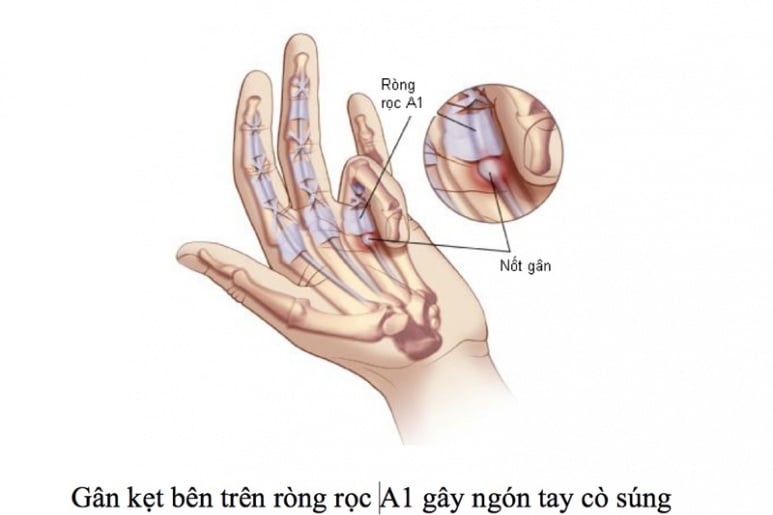 Ngón tay cò súng - Ảnh minh họa 4