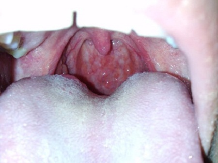 Viêm bạch huyết vòm họng - Ảnh minh họa 1