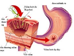 Viêm dạ dày mạn tính - Ảnh minh họa 2