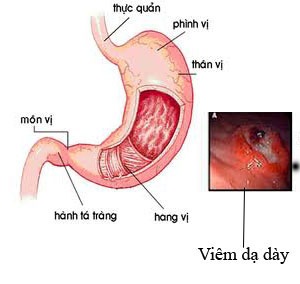 Viêm dạ dày mạn tính - Ảnh minh họa 4