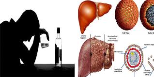Viêm gan do rượu - Ảnh minh họa 4