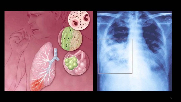Viêm phổi không điển hình - Ảnh minh họa 1