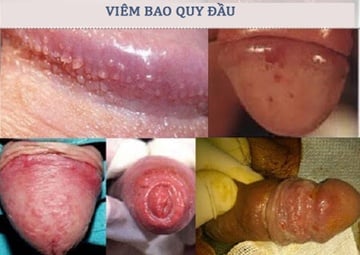 Viêm quy đầu - Ảnh minh họa 2