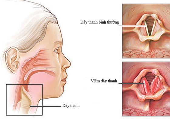 Viêm thanh quản hầu - Ảnh minh họa 2