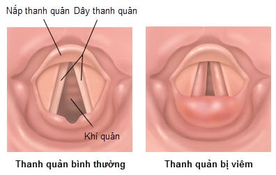 Viêm thanh quản hầu - Ảnh minh họa 3