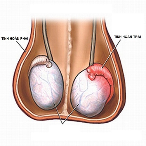 Viêm tinh hoàn - Ảnh minh họa 3